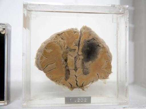 Мужчина воровал мозги из медицинского музея и продавал их на Ebay