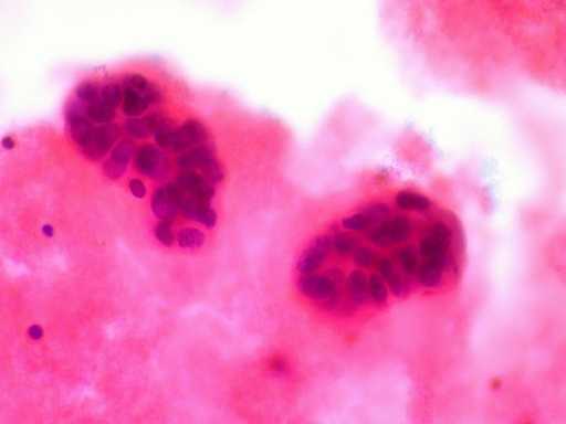 Биологический маркер помогает определить риск развития рака молочной железы