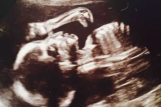 Беременная женщина была ошеломлена, когда увидела на своей эхограмме  изображение динозавра