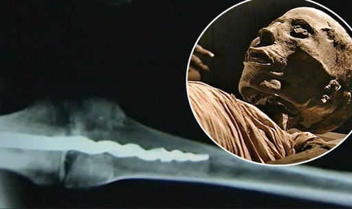 Was surgery performed on Egyptians? Prosthetic pin in 3000-year-old mummy discovered