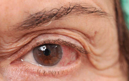 Способы борьбы с хроническим синдромом сухого глаза