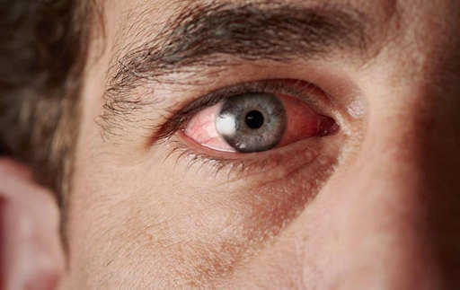 Понимание причин хронического сухого глаза
