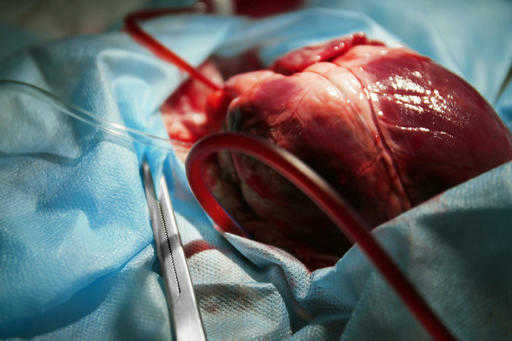 Свињско срце пресађено људима први пут у САД