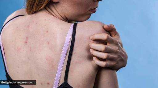 Индия - Прыщи на теле: знайте, что это такое, и способы лечения состояния кожи