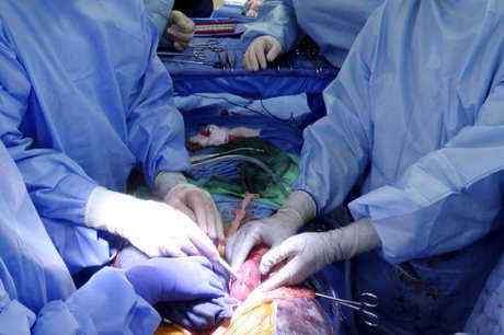 Американские исследователи тестируют трансплантацию свиньи человеку в донорском теле