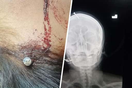 A resident of Pakistan drove a nail into her head on the advice of a “healer”