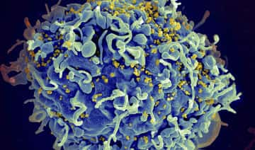 Första kvinnan rapporterades botad från HIV efter stamcellstransplantation
