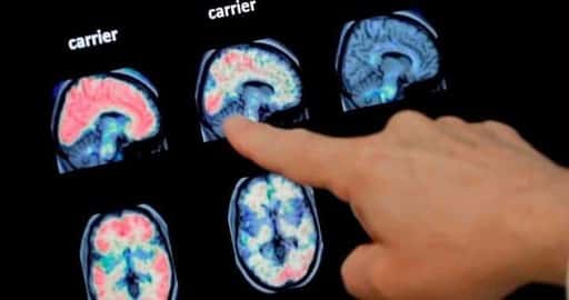 Kanada – New Brunswick odstraňuje pacientov z údajného klastra „záhadnej choroby mozgu“.