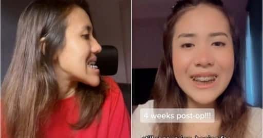 La cosa più spaventosa che abbia mai passato: la donna di Singapore condivide un'esperienza di chirurgia della mascella da $ 26.000 su TikTok