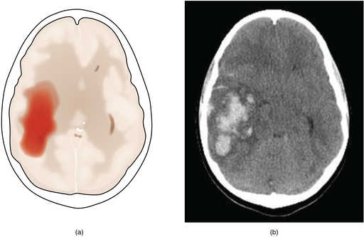 In Russland wurde ein Assistenzprogramm für neurochirurgische Operationen eingerichtet